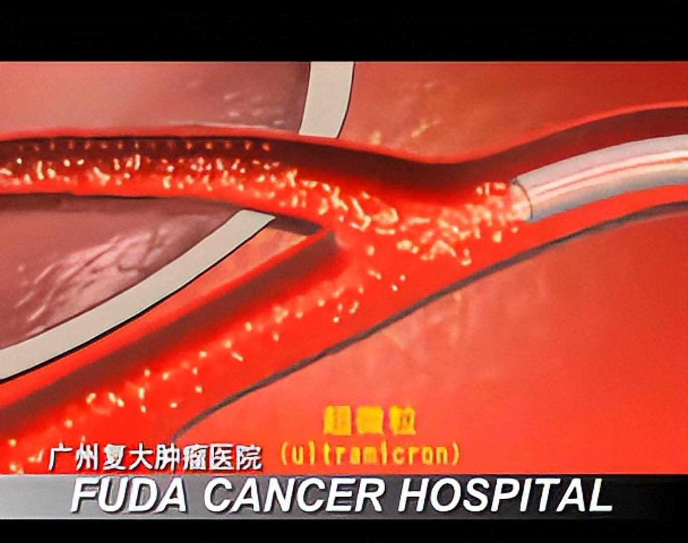 腫瘤微血管介入療法 (CMI)